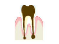 虫歯の進行と治療方法
